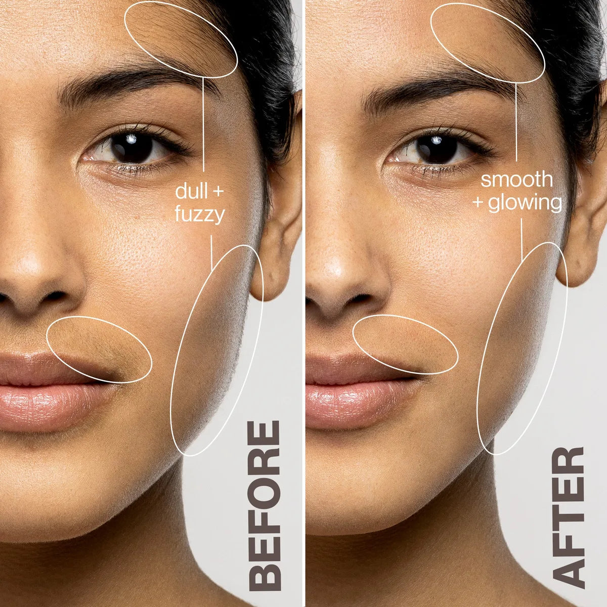 Somnei LUXE+ before and after result 1