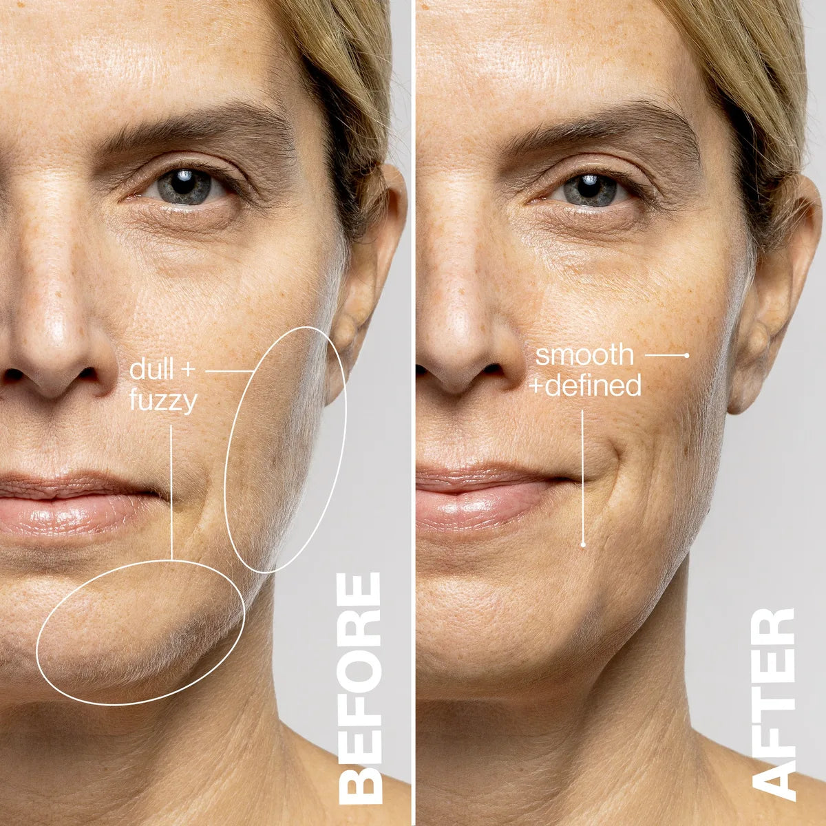 Somnei LUXE+ before and after result 3