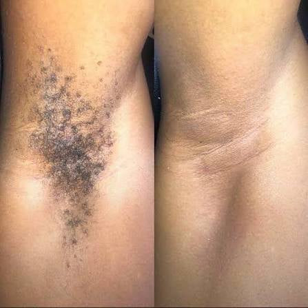 Before and after result 3