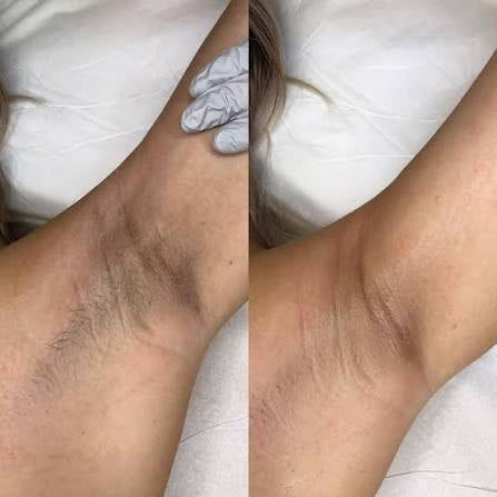 Before and after result 4
